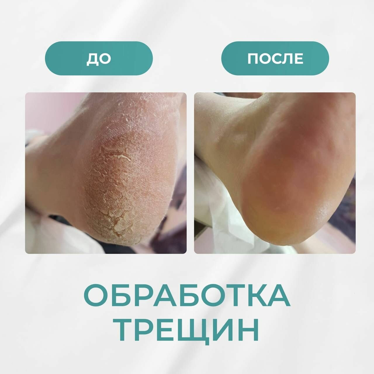 трещины на пятках, педикюр, от трещин на пятках, трещины на стопах, сухие пятки