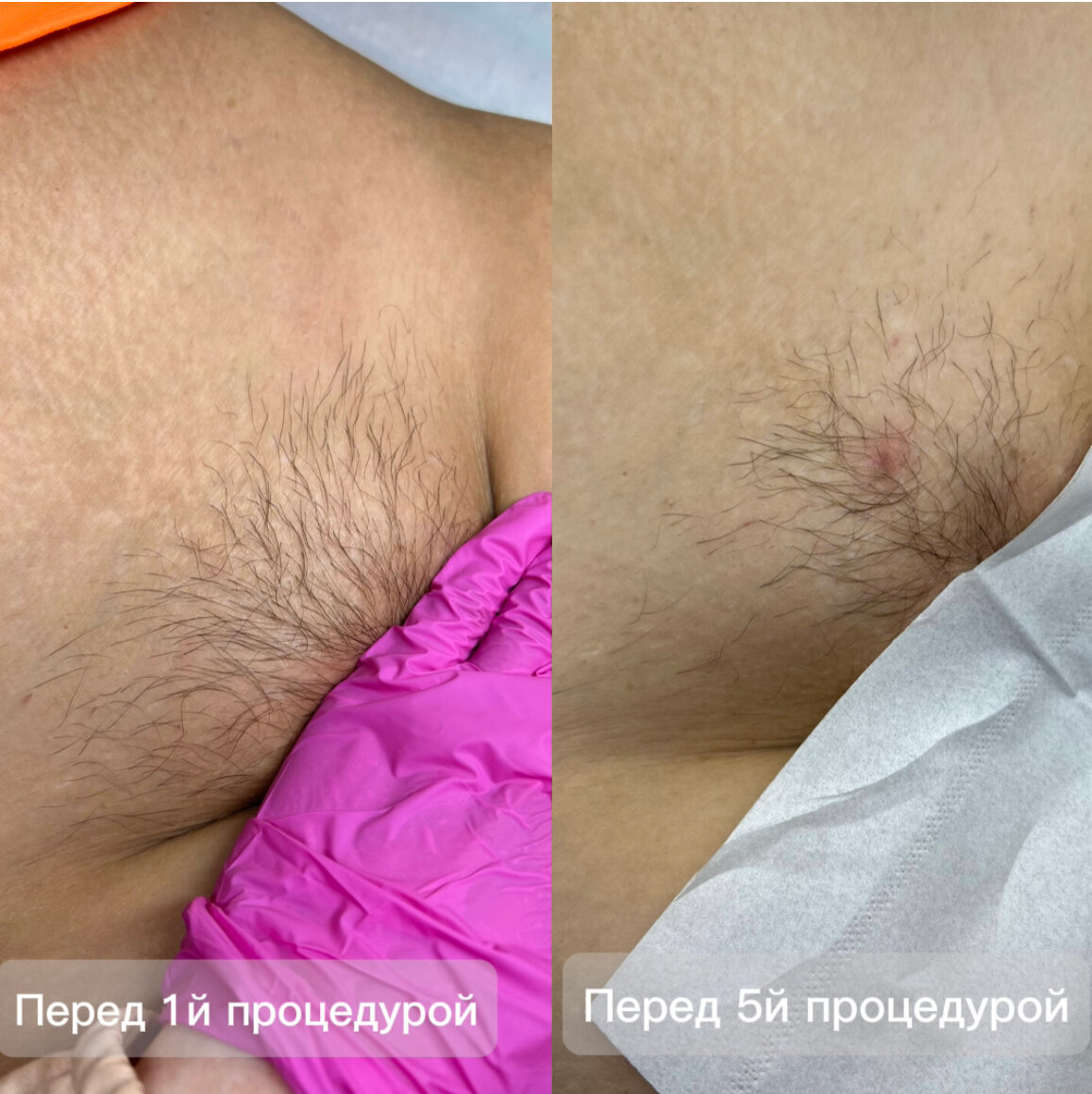 восковая депиляция, депиляция, бикини депиляция, сахарная депиляция, эпиляция