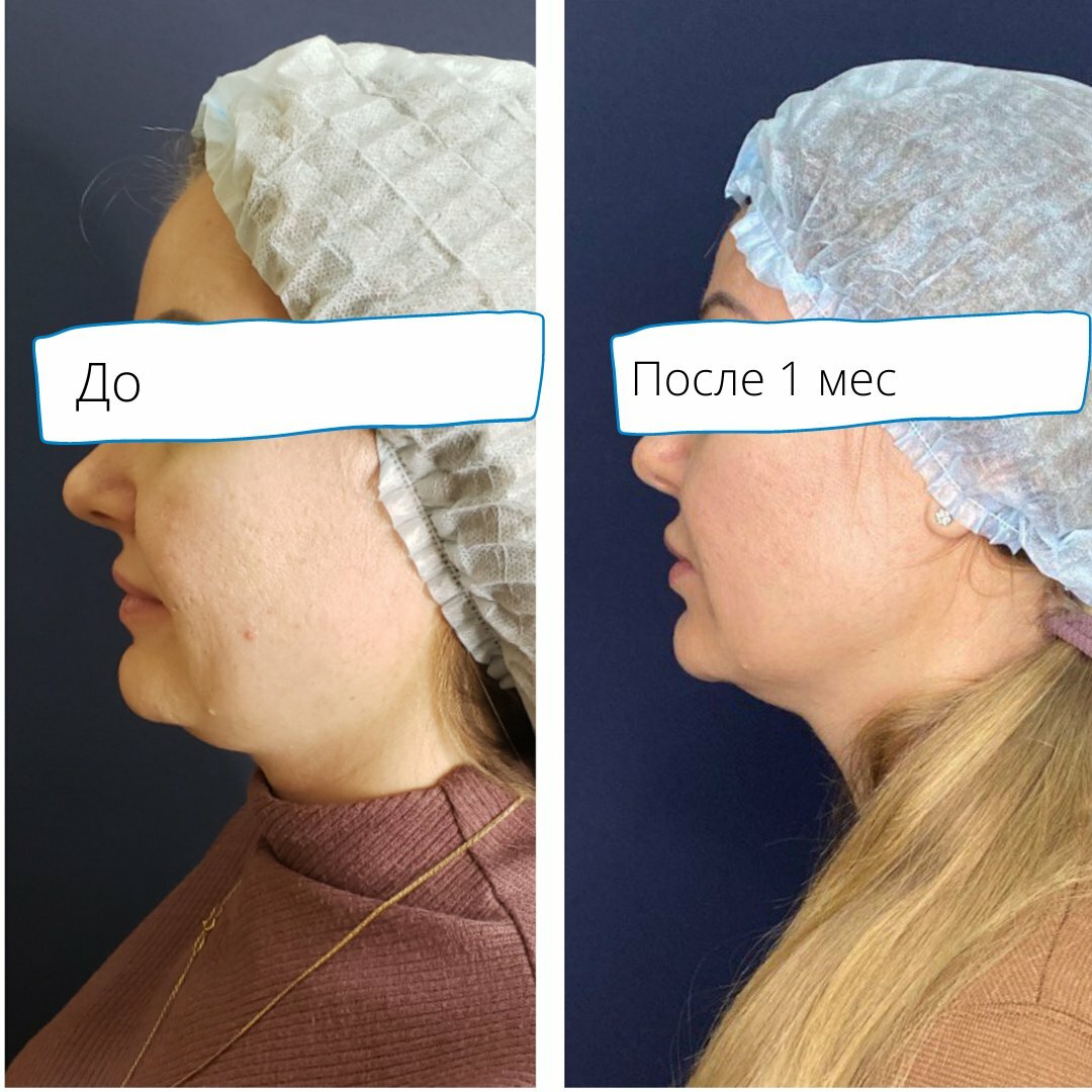 тредлифтинг, липосакция подбородка, нити косметология, нитевой лифтинг, подтяжка лица