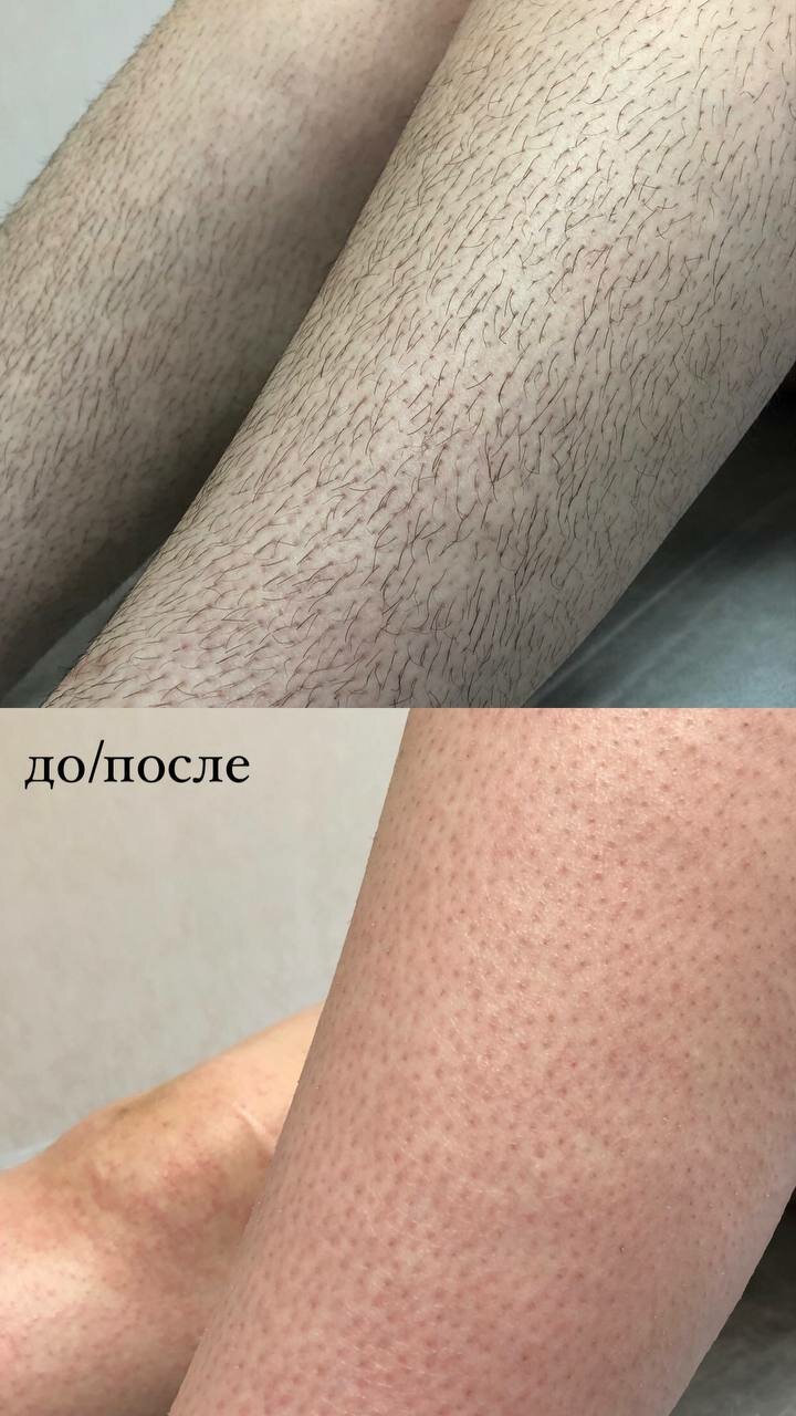 восковая депиляция, депиляция сахаром, депиляция, шугаринга, депиляция воском
