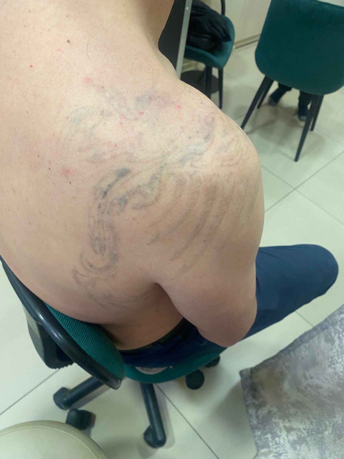 удаление татуировок лазером, сведенная татуировка, удаление татуировок, удаление тату лазером, татушки