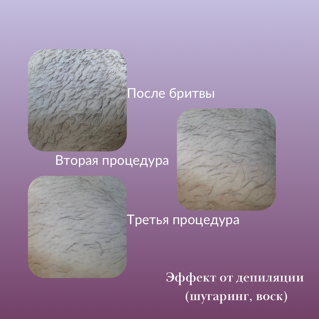 электроэпиляция после процедуры, восковая депиляция, депиляция, воск депиляция, депиляция зоны