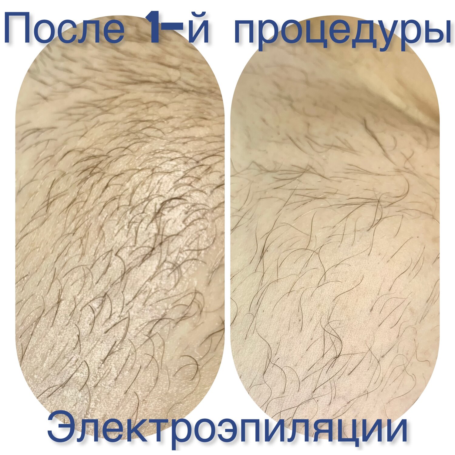 восковая депиляция, электроэпиляция, лазерная эпиляция, эпиляция, депиляция