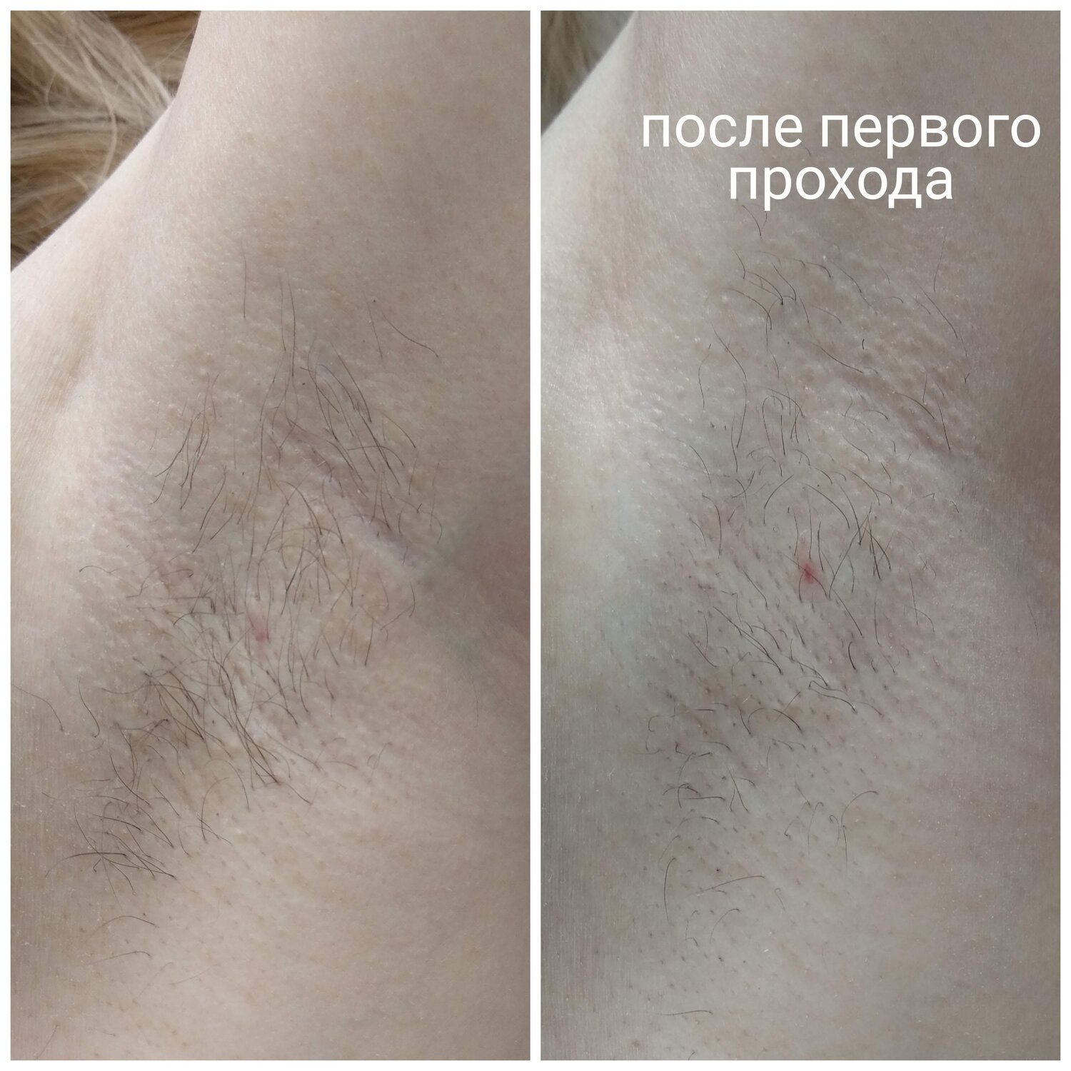 восковая депиляция, депиляция, шугаринг подмышек, эпиляция, восковая депиляция бикини