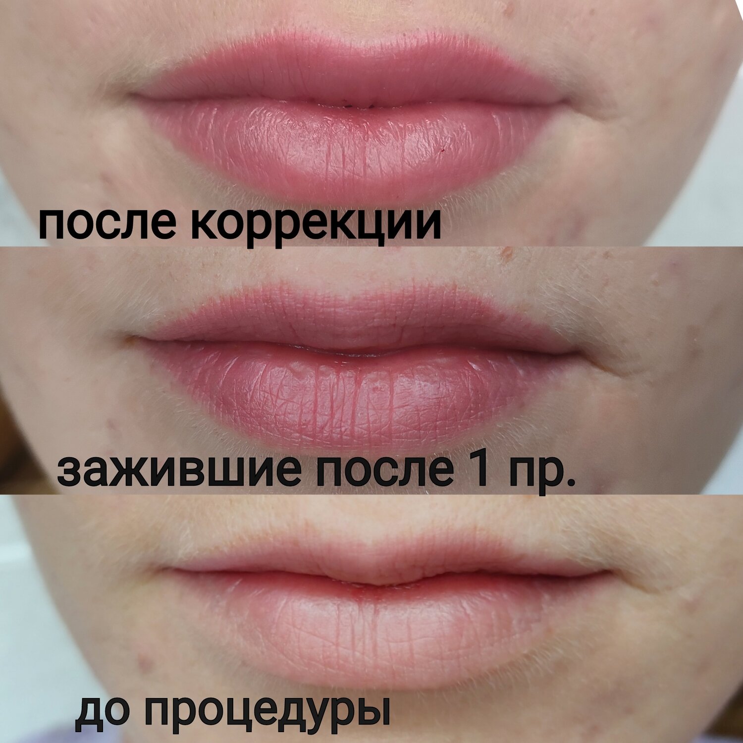 губы после увеличения, губы гиалуроновой кислотой, губы гиалуроновой, увеличение губ, татуаж губ