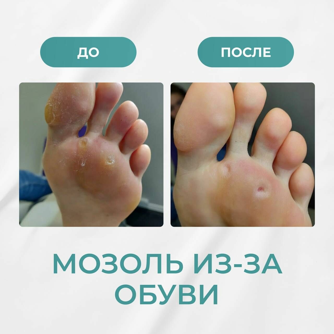 стержневая мозоль, сухая мозоль, мозоль натоптыш, стержневая мозоль лечение, удаление стержневой мозоли