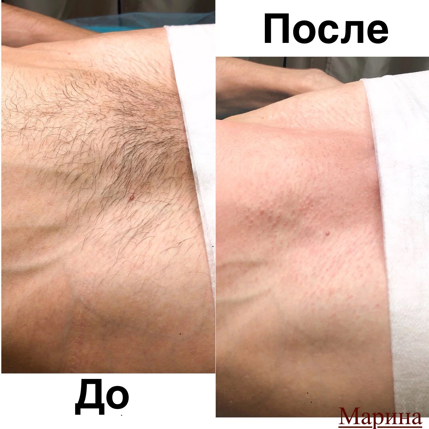депиляция воском, мужской шугаринг глубокое, мужская депиляция, восковая депиляция, мужская депиляция бикини
