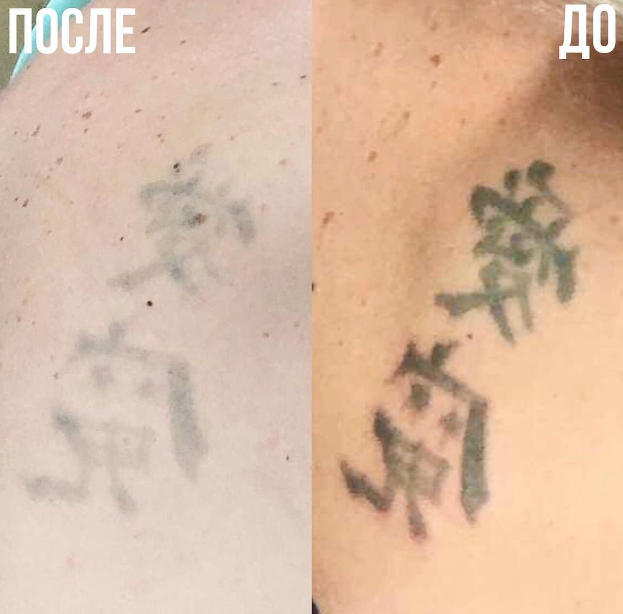 выведение тату лазером, удаление татуировок лазером, удаление тату лазером, лазерное удаление татуировок, сведение тату лазером