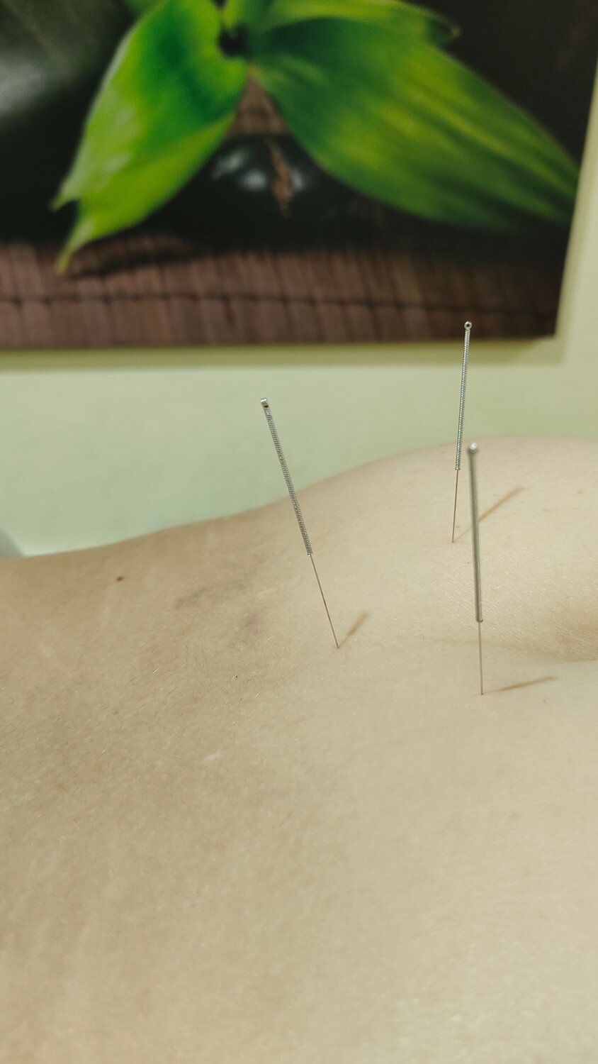 иглоукалывание, иглорефлексотерапия, иглотерапия, acupuncture, иглоукалывание для похудения