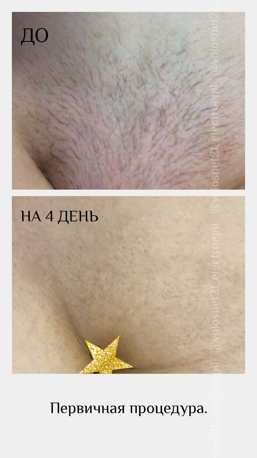 лазерная депиляция зоны бикини, глубокое бикини шугаринг, депиляция бикини, депиляция воском глубокое бикини, депиляция