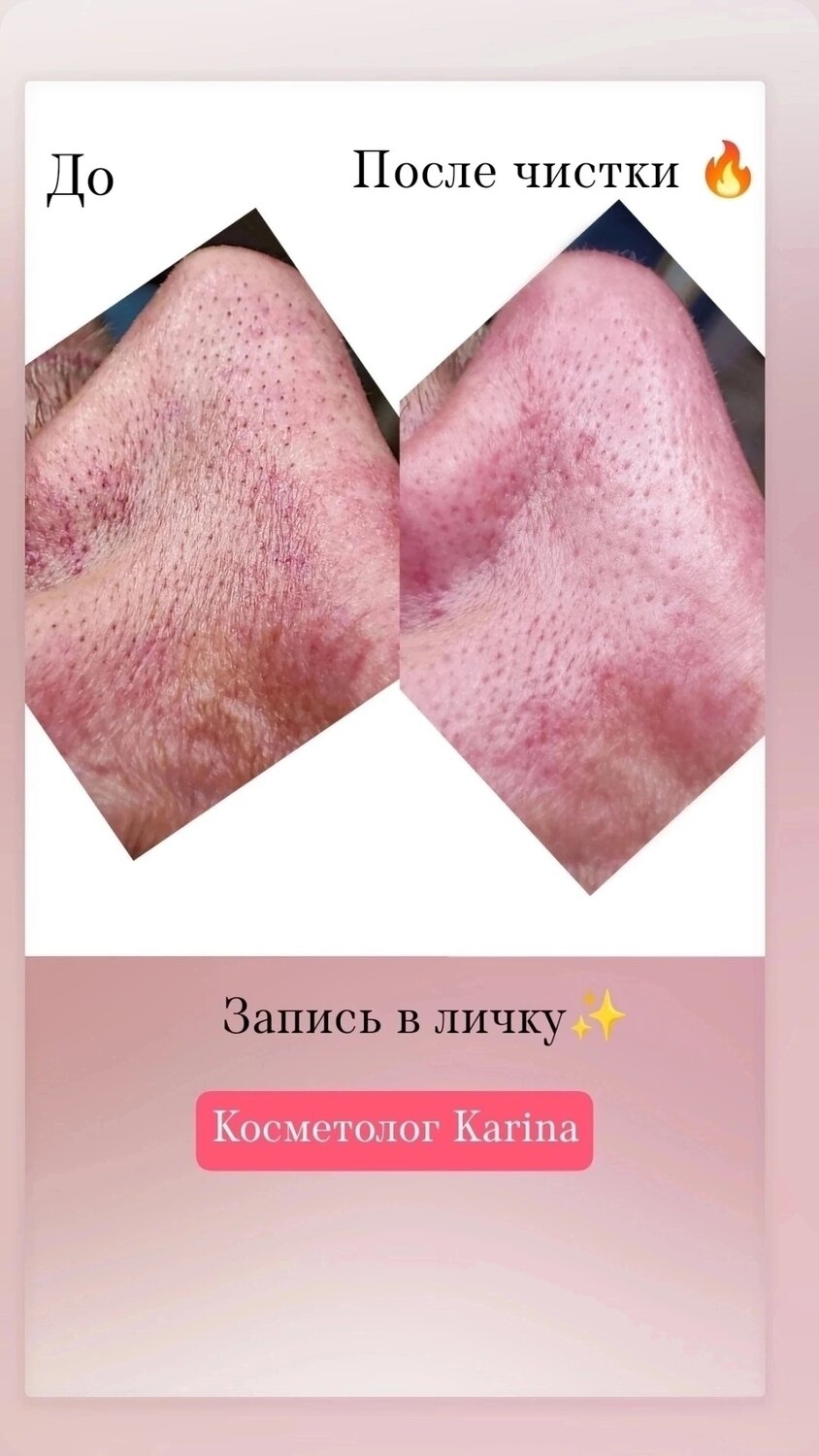 после чистки лица, уз чистка лица, комбинированная чистка лица, чистка лица, комплексная чистка лица