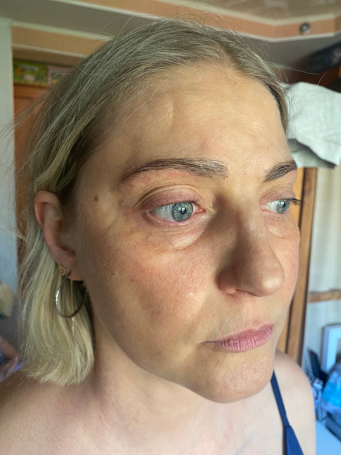 блефаропластика, блефаропластика век, блефаропластика нижних век, нижняя блефаропластика, макияж бровей