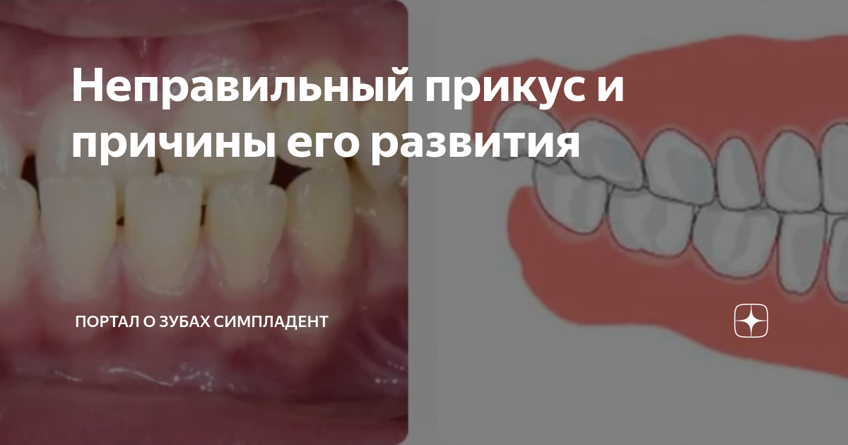 «Неправильный прикус и причины его развития» — Яндекс Кью