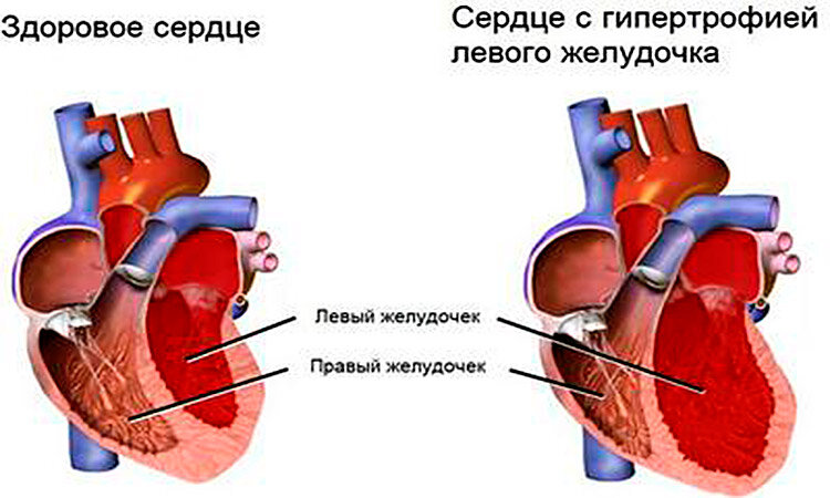 Желудочки сердца фото Что делать, если увеличен левый желудочек сердца?" - Яндекс Кью