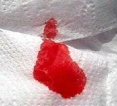Кровь Из Ануса После Секса