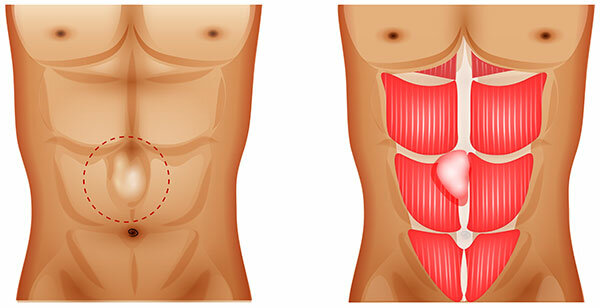 Грыжа Белого Живота Фото