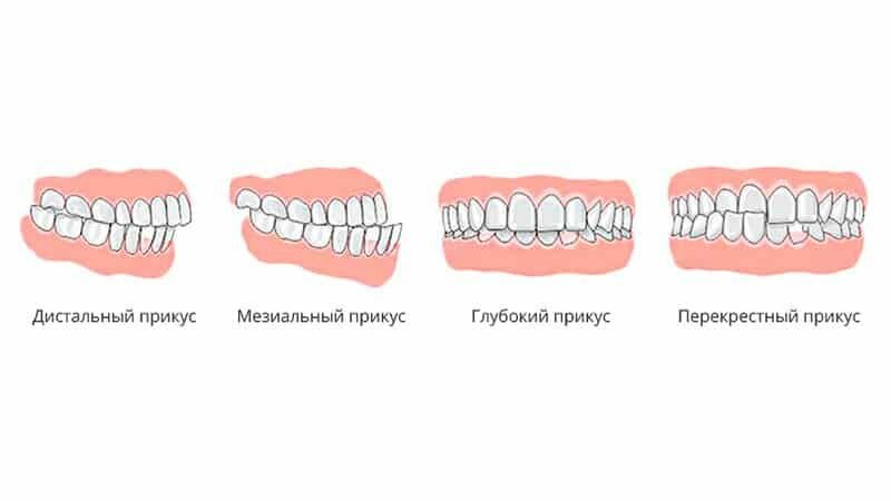 Спрашивали про что такое правильный прикус, отвечаем Григорий Щербаков ВКонтакте