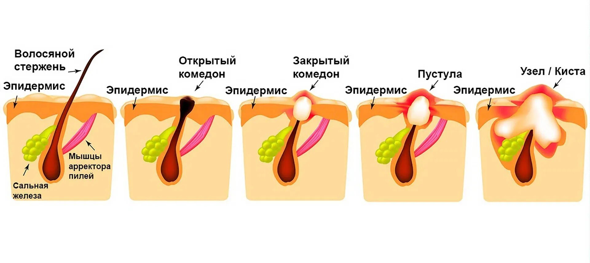 Как выглядят пустулы на лице