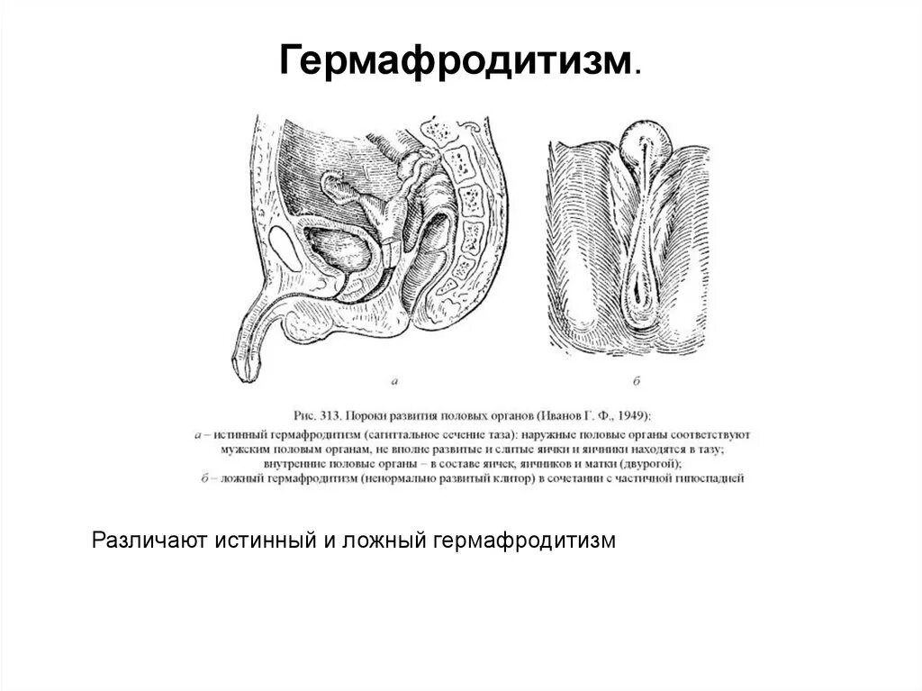 Мужской ложный гермафродитизм Аномалии генетического и гонадного пола Гермафроди