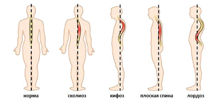 Лордоз кифоз сколиоз рисунок