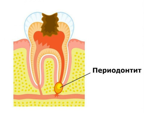 Периодонтит.jpg