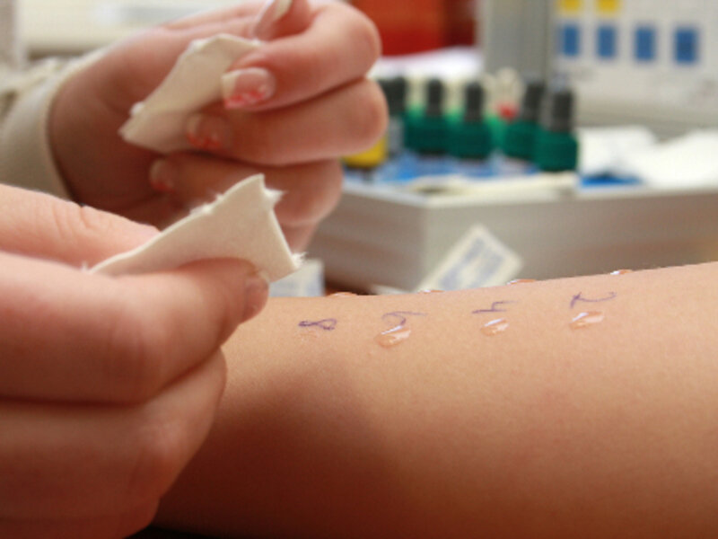 «Крапивница у детей: фото, симптомы, лечение» — Яндекс Кью