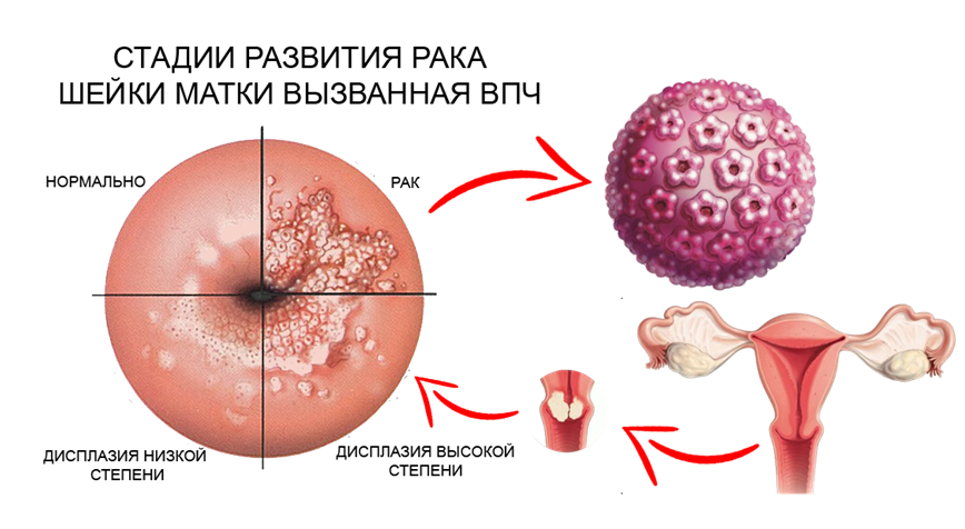 A HPV és a méhnyakrák kapcsolata