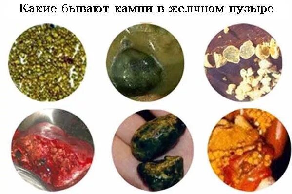 Камни в желчном пузыре – причины, симптомы и лечение» — Яндекс Кью