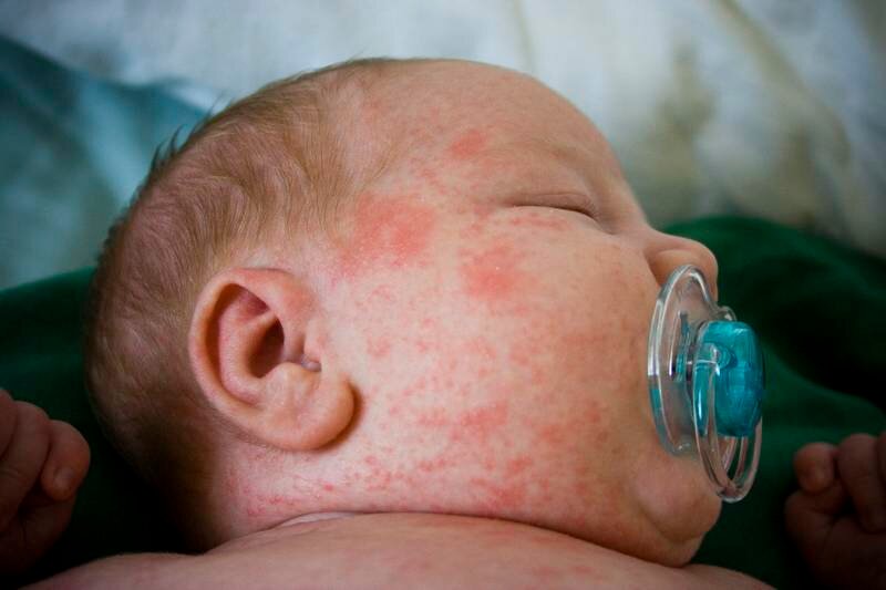 Аллергическая сыпь у новорожденного