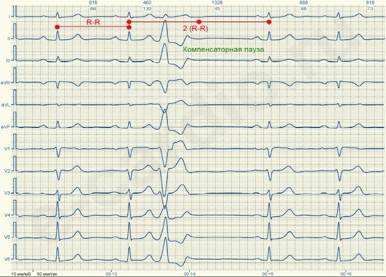 «Что такое желудочковая экстрасистолия: лечение и последствия» — Яндекс Кью