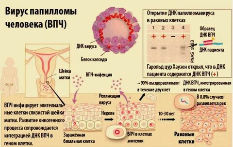 ВПЧ перерождение в рак.jpg