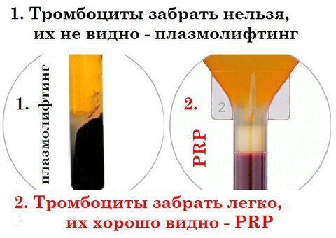 prp плазмолифтинг - разница mc-rost.ru.jpg