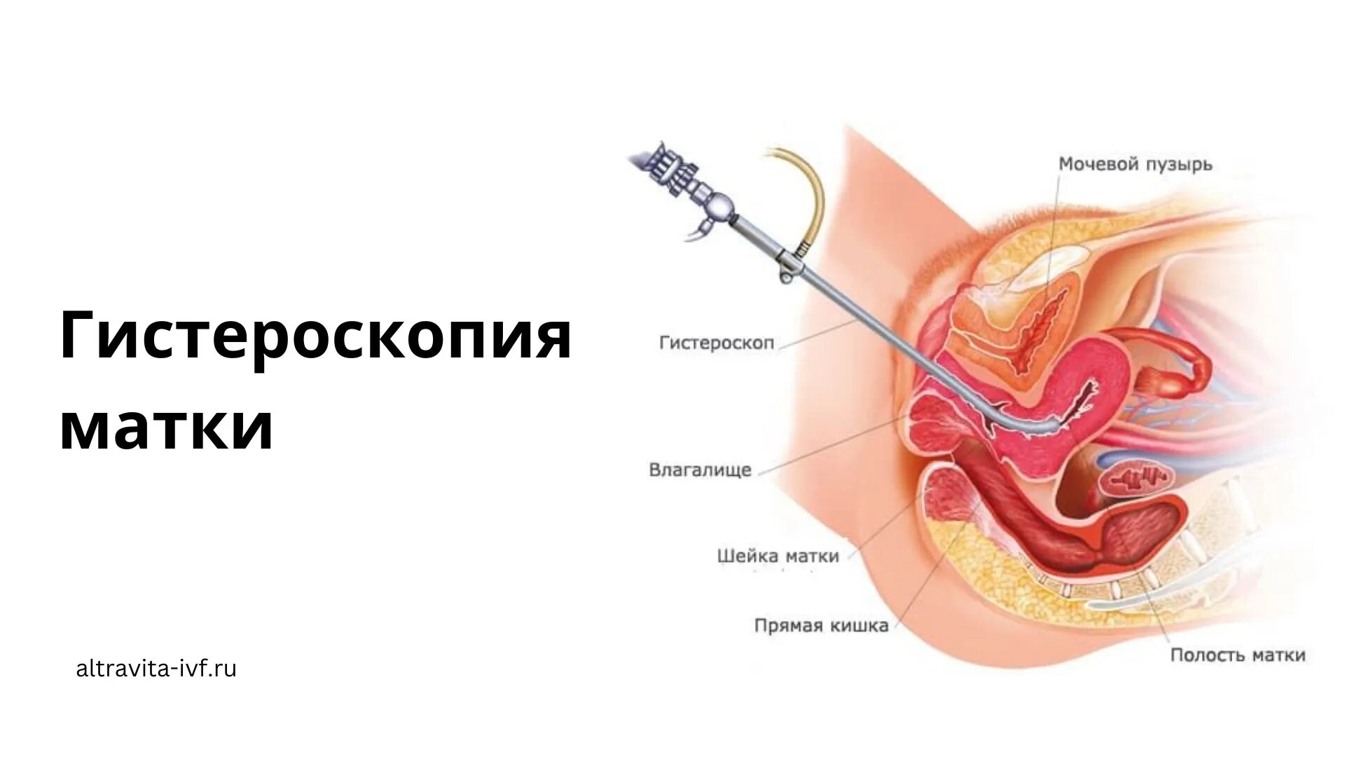 оргазм с удаленной маткой и яичниками фото 99