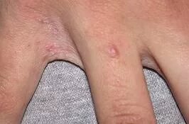 Аллергия на коже рук: причины появления, виды, как вылечить аллергию на руках, кистях, пальцах