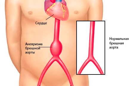 Где Находится Аорта У Человека Фото