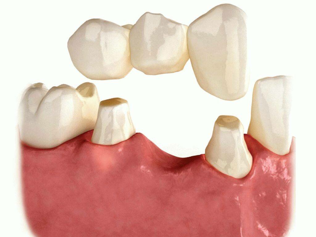 Как делают мосты зубов