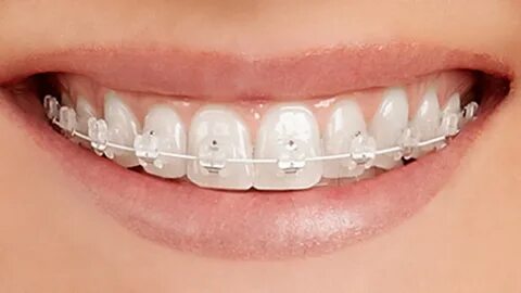 Types of orthodontic treatments