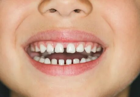 Widely spaced teeth