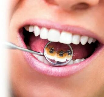 Customized Lingual Braces Means Your Smile is Uniquely Yours