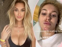 Model Veronika Rajek Reveals Painful Face Injuries After Scooter Crash! - Perez Hilton