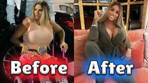 Katie Price shows the 16th breast augmentation surgery, hoping to earn more money! - YouTube