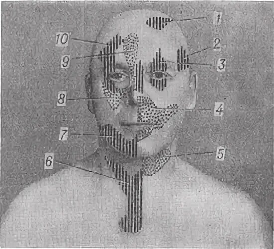 невралгия тройничного нерва клиника. приступообразные боли в одной половине лица. односторонняя головная боль. невралгия тройничного лицевого нерва. для неврита тройничного нерва характерны.