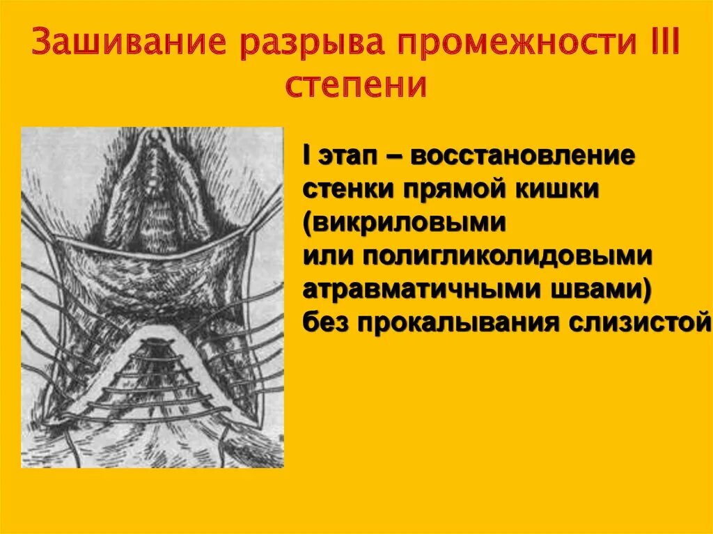 Степени разрыва промежности. Разрыв промежности стадии. Ушивание разрыва промежности. Разрыв промежности III степени.