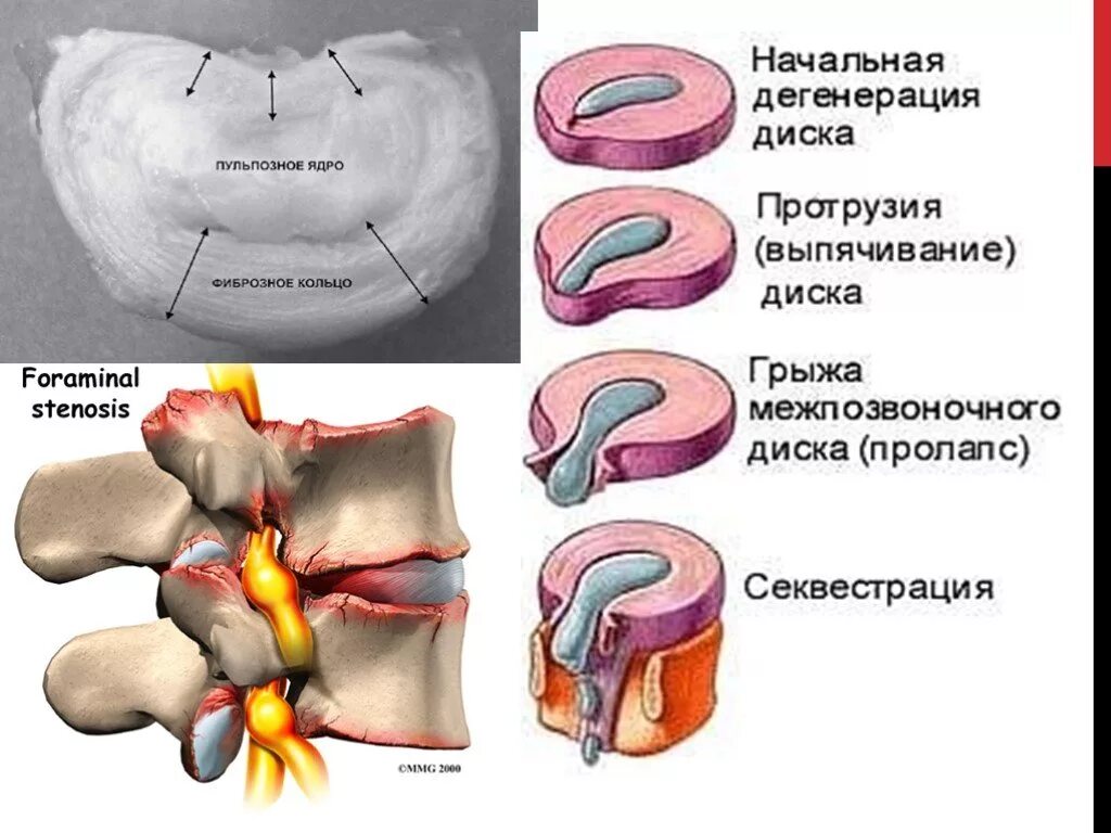 Пульпозное ядро и фиброзное кольцо. Грыжа позвоночника пульпозное ядро. Пульпозное ядро межпозвоночного диска грыжа. Пульпозное ядро межпозвоночного диска остеохондроз.