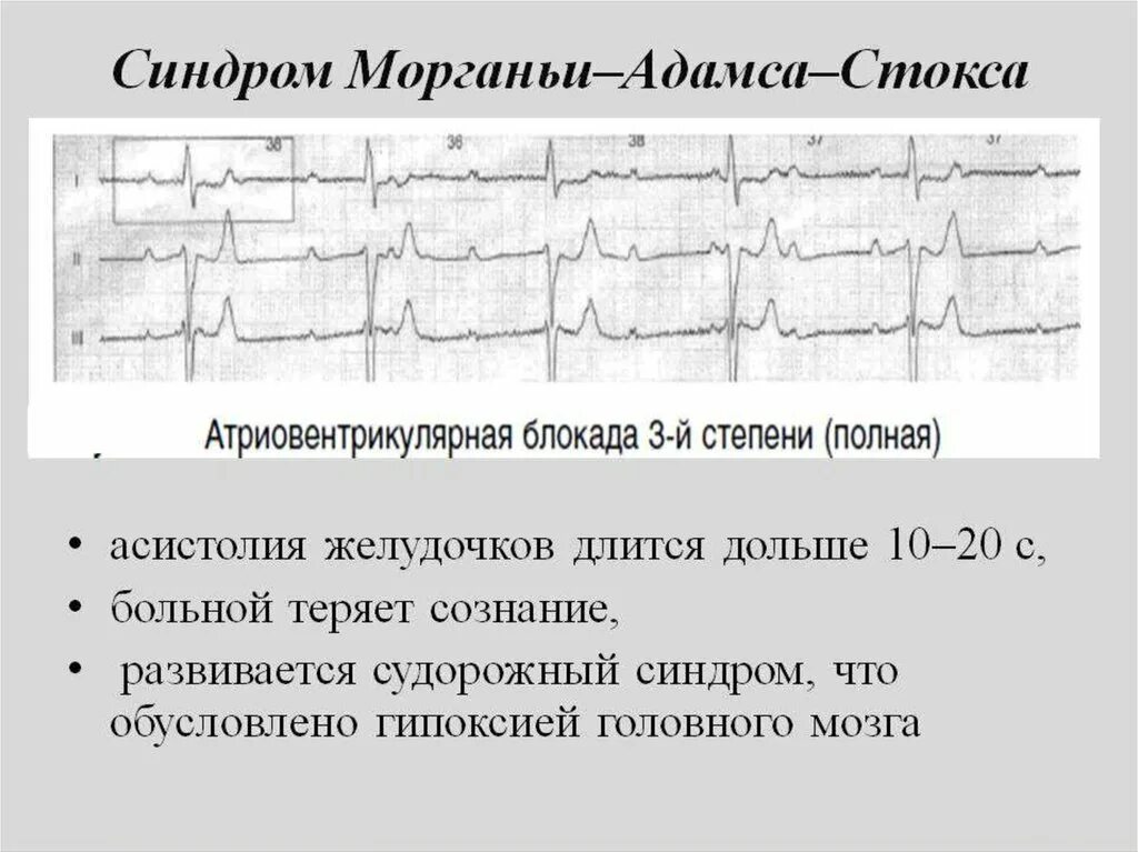 Блокада правого желудочка. Синдром Морганьи-Адамса-Стокса. Синдром Морганьи Адамса Стокса на ЭКГ. АВ блокада 3 степени синдром Морганьи Адамса Стокса. Синдром мас на ЭКГ признаки.