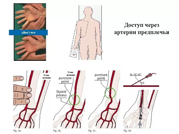 Правая лучевая артерия. Пункция артерии по Сельдингеру. Пункция радиальной артерии. Пункция и катетеризация лучевой артерии. Методика пункции бедренной артерии.