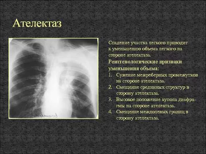 Синдром обтурационного ателектаза симптомы. Сегментарный ателектаз легкого рентген. Травматический ателектаз легкого проявляется:. Обтурационный ателектаз легкого рентген. Обтурационный ателектаз легкого