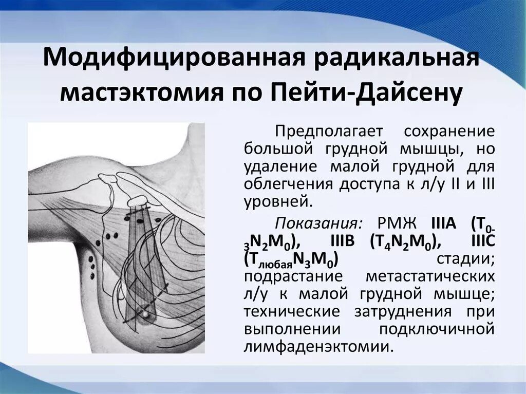 Удаление груди и лимфоузлов. Модифицированная радикальная мастэктомия по Маддену. Радикальная мастэктомия по пейти-Дайсону. Ракидальная Мактэктомия. Радиальная местаэкьомия.