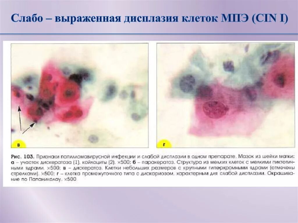 Плоское интраэпителиальное поражение низкой степени. Дисплазия шейки матки цитология. Дисплазия клеток плоского эпителия. Дискератоз эпителия матки.