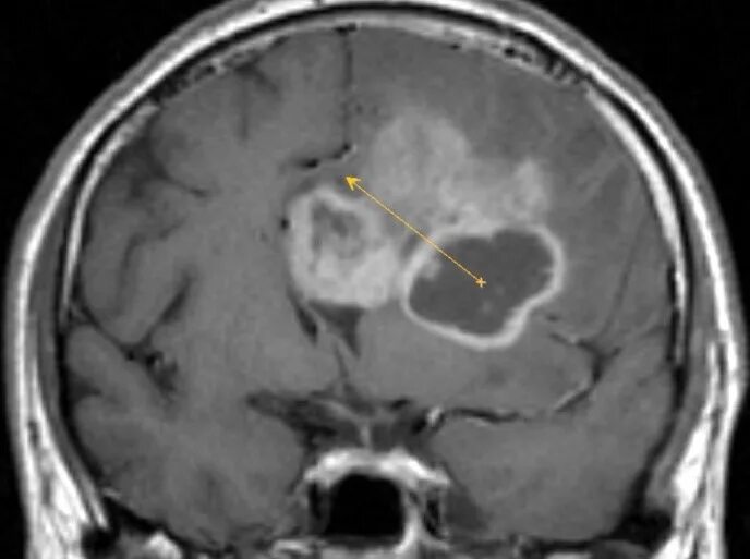 Боли при менингиоме. Менингиома лобной кости кт. Петрокливальная менингиома. Обызвествленная менингиома кт. Боли при менингиоме.